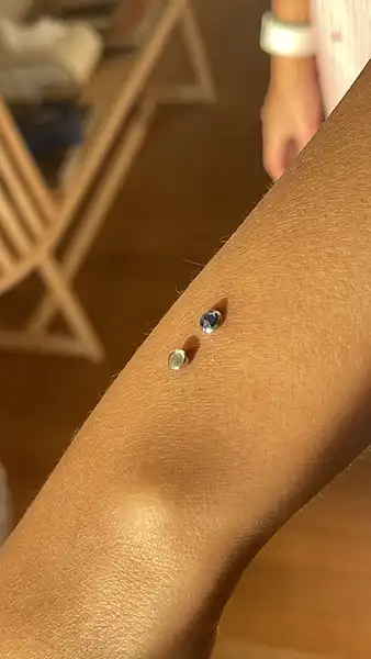 2 implantes microdermales en la muñeca de una chica