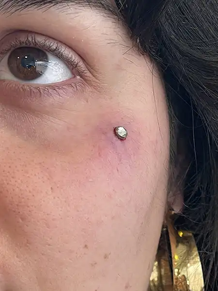 Piercing microdermal en el pómulo con base de titanio y joya plana - Estudio en Barcelona